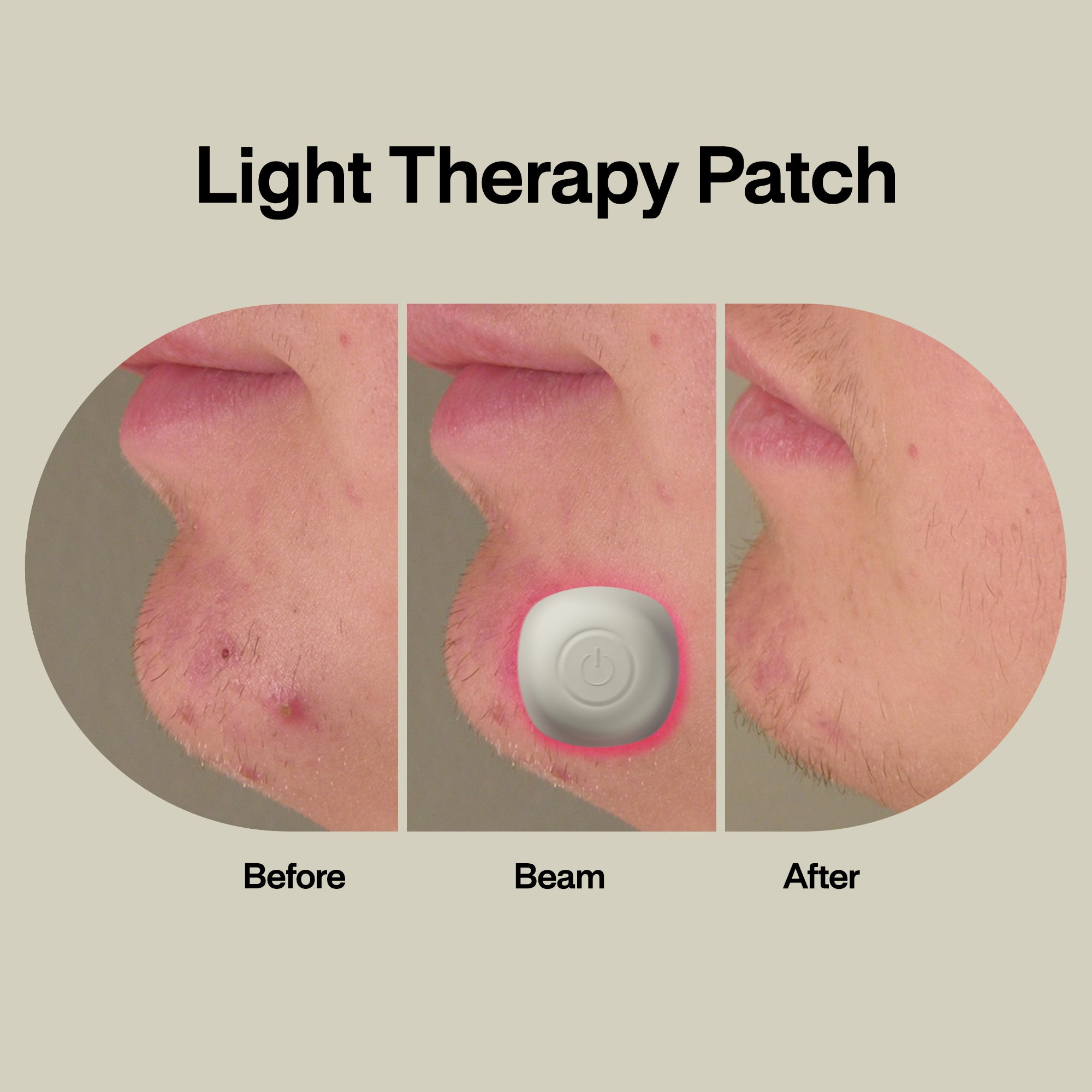 Acne Light Therapy Patch (2-Pack)