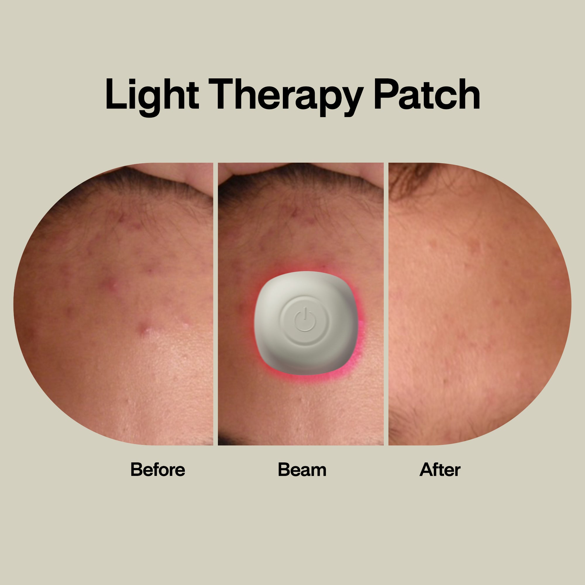 Acne Light Therapy Patch (1-Pack)