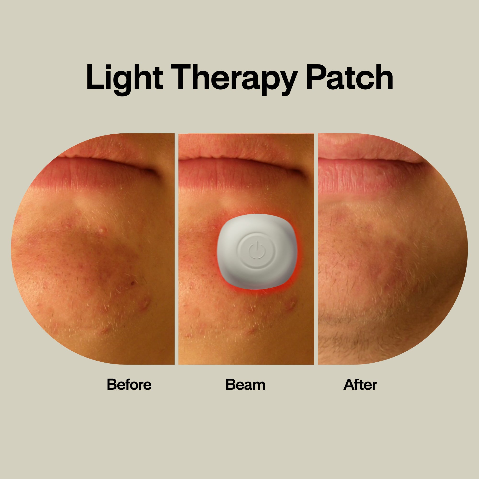 Acne Light Therapy Patch (1-Pack)